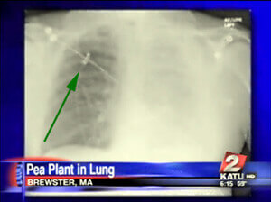 pea-in-lung